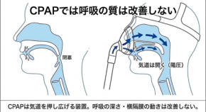 睡眠時無呼吸症候群対策のCPAPはベストな選択肢とは言えない━━CPAPでは