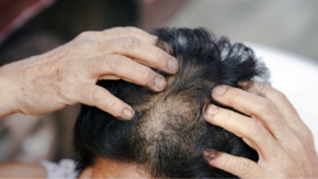 デジタルで作る“治療を続ける力”。AGA管理アプリに14日間習慣化、新プログラム