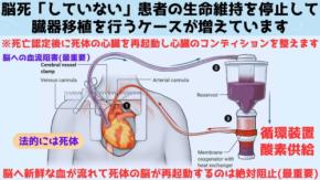 心臓を「眠らせて保存する」新発想のREUP法が多くの命を救っている