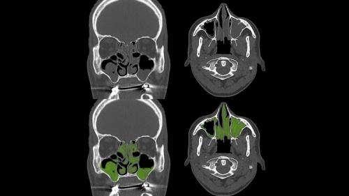 長引く鼻の炎症、治療の正解は?
