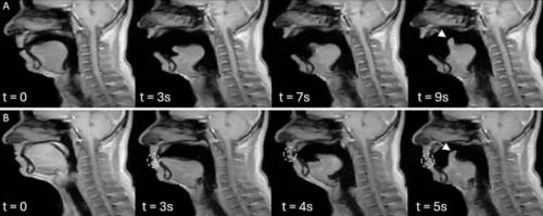 研究ではMRIを使用して、あくびの様子を詳細に記録し分析した