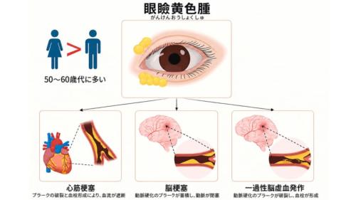 眼瞼黄色腫（がんけんおうしょくしゅ）は他の病とかかわっている