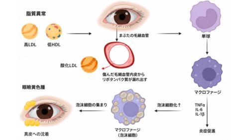 黄色腫の特徴である斑点は、コレステロールやその他の脂肪で満たされている。