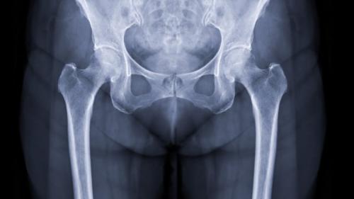 たった1度の点滴で骨折は94%減少、骨強度も増加