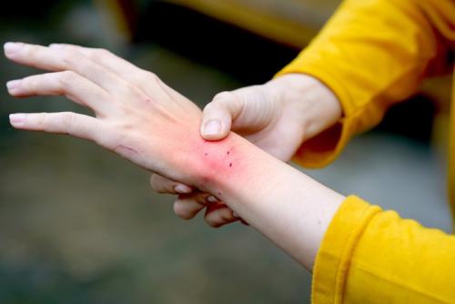 猫の噛み傷が赤く腫れた女性の手