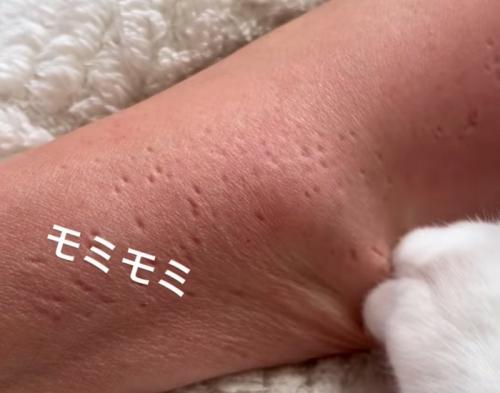 腕の爪痕