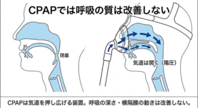 CPAPで眠れないのはなぜか？睡眠時無呼吸治療の構造的課題を解説