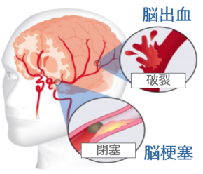 日本発・脳梗塞治療薬候補「TMS-007」、治療可能時間を5倍に広げる挑戦