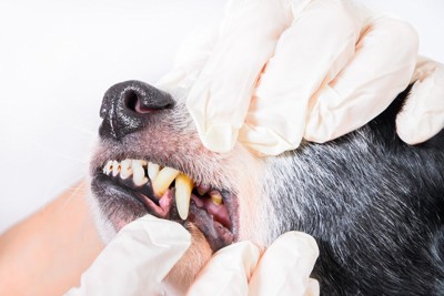 歯の根元に歯石